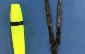 ირაკლი თოდუა: "პაციენტს 25 წლის წინ ოპერაციისას ჩატოვებული პინცეტი ამოვუღეთ"