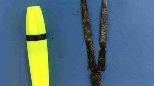 ირაკლი თოდუა: "პაციენტს 25 წლის წინ ოპერაციისას ჩატოვებული პინცეტი ამოვუღეთ"