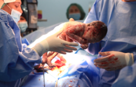 ზაზა სინაურიძემ მშობიარე გოგონა პლაცენტა პერკრეტას სასიკვდილო დიაგნოზისგან იხსნა - "მსგავსი ოპერაცია მსოფლიო მედიცინაში აღწერილი არ არის"