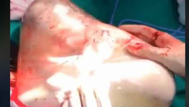 ქართულ კლინიკაში ქირურგმა ბავშვი აპკიანად ამოიყვანა - საოცარი ვიდეო, რომელიც ემოციებით აგავსებთ