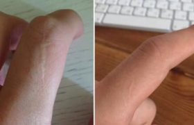 კაცების 90 პროცენტს მარცხენა საჩვენებელ თითზე ნაიარევი აქვს კაცების 90 პროცენტს მარცხენა საჩვენებელ თითზე ნაიარევი აქვს