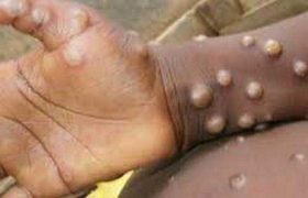 მაიმუნის ყვავილი უკვე საქართველოშია - ,,კონტაქტებს არ გადასდებიათ"