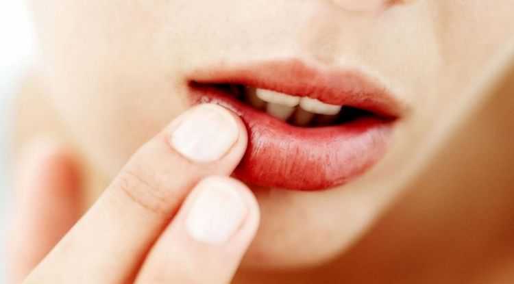 როგორ დაამარცხოთ ჰერპესი მარტივად