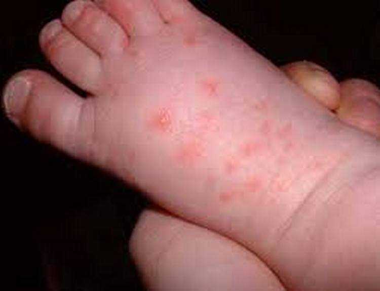 ვის ემუქრება ჩუტყვავილა - პროფილაქტიკისთვის არსებობს 2 გზა